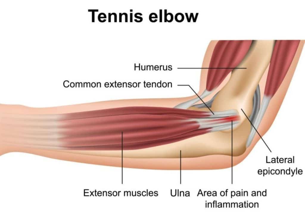 Can You Get Tennis Elbow from Playing Pickleball?
